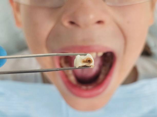 Best Emergency Wisdom Teeth Removal in Cookeville, TN