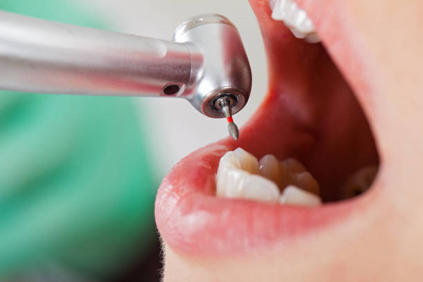Best Emergency Tooth Extraction in Cookeville, TN